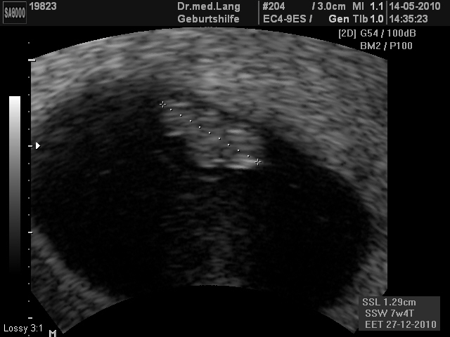 Ultraschall 8SSW 02