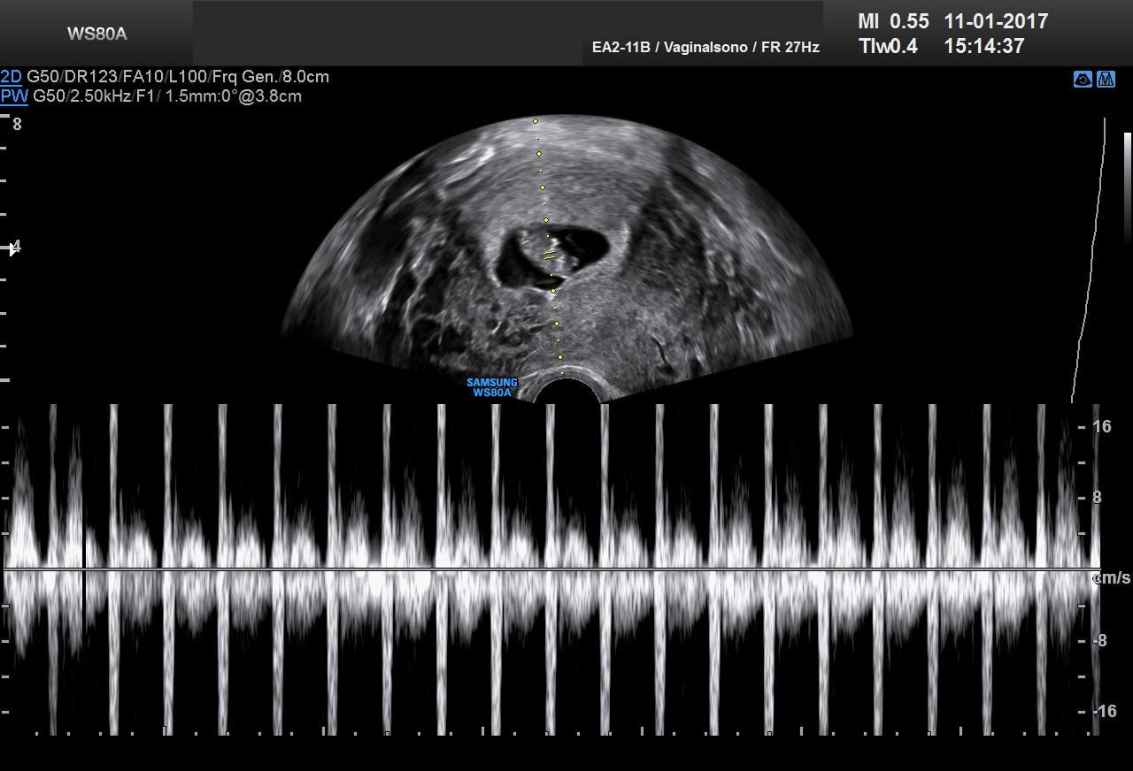 Ultraschall 8SSW 03