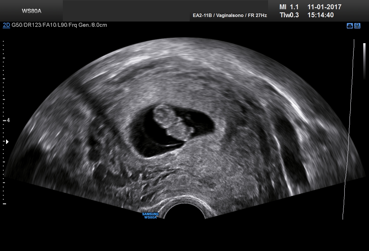 Ultraschall 8SSW 04